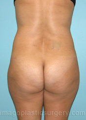 Before liposuction back view female patient case 3782