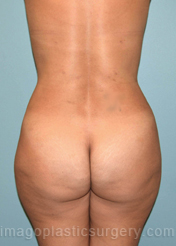 After liposuction back view female patient case 3782