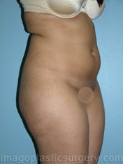 Before liposuction right 3/4 side view female patient case 3785