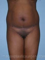 Before liposuction front view female patient case 3791
