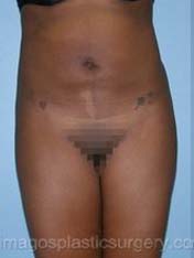 After liposuction front view female patient case 3791