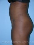 Before liposuction left side view female patient case 3791