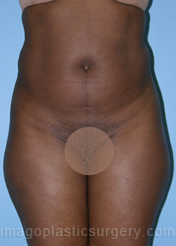 Before liposuction front view female patient case 3796