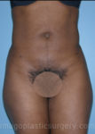 After liposuction front view female patient case 3796