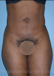 After liposuction front view female patient case 3796