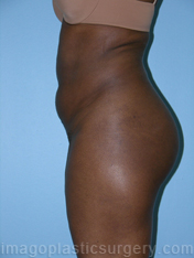 Before liposuction left side view female patient case 3796