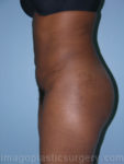 After liposuction left side view female patient case 3796
