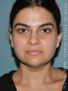 Before facial liposuction female patient front view case 3819