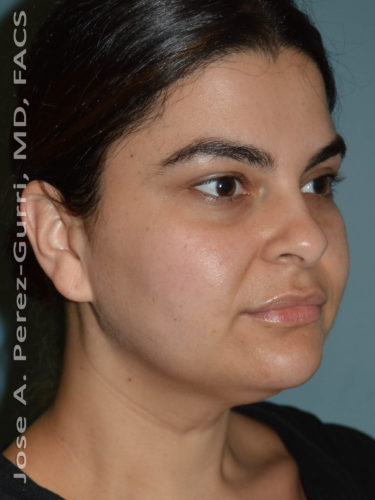Before facial liposuction female patient right 3/4 angle case 3819