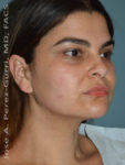 After facial liposuction female patient right 3/4 angle case 3819