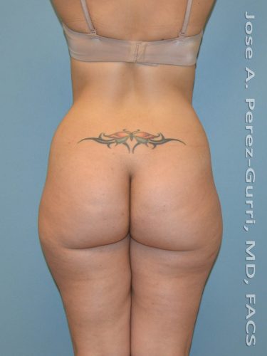 Before liposuction back view female patient case 3826
