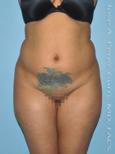 Before liposuction front view female patient case 3845