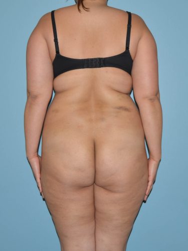 Before liposuction back view female patient case 3858