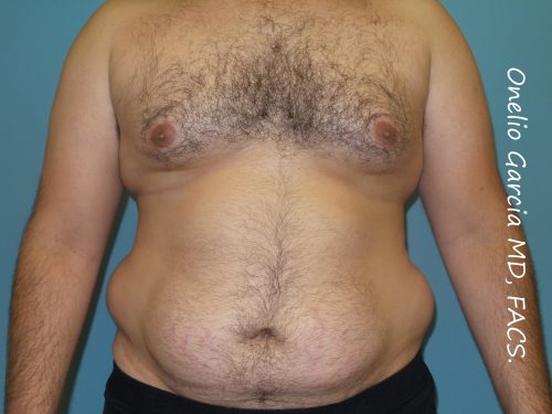 Before liposuction front view male patient case 4229