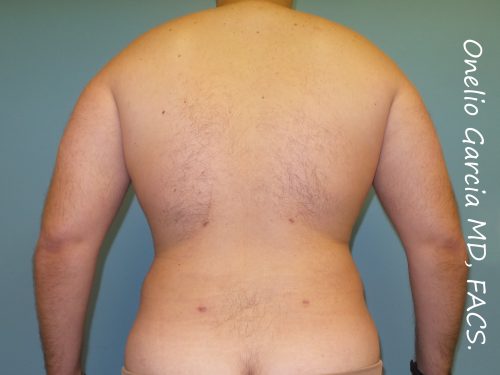 After liposuction back view male patient case 4229