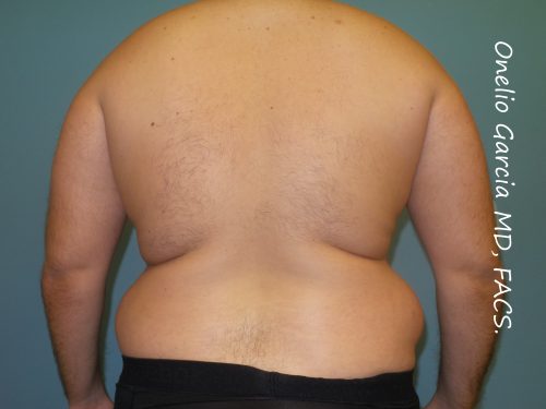 Before liposuction back view male patient case 4229