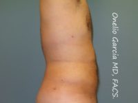 After liposuction right side view male patient case 4229