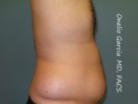 Before liposuction right side view male patient case 4229