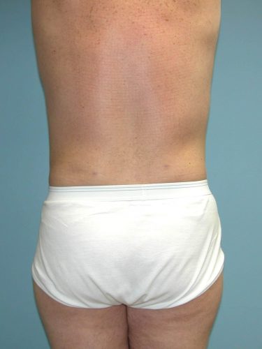 After liposuction male patient back view case 4262
