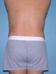 After liposuction male patient back view case 4314