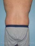 Before liposuction male patient right back view case 4314