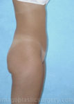before right side view mini tummy tuck of female patient 2937