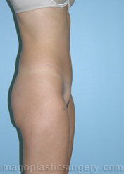 after right side view mini tummy tuck of female patient 2937