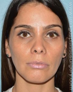 After rhinoplasty front view female patient case 5050