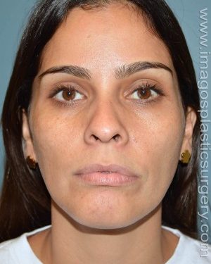 Before rhinoplasty front view female patient case 5050