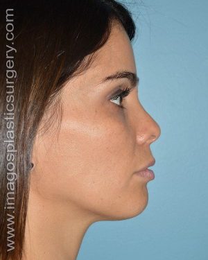 After rhinoplasty right side view female patient case 5050