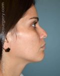 Before rhinoplasty right side view female patient case 5050