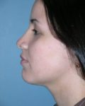 After rhinoplasty left side view female patient case 5055