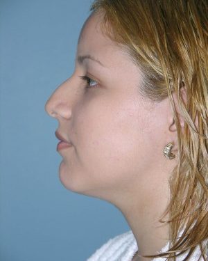 Before rhinoplasty left side view female patient case 5055