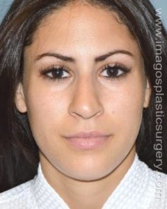 Before rhinoplasty front view female patient case 5063