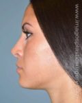 After rhinoplasty left side view female patient case 5063