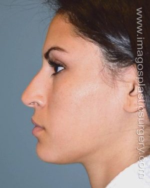 Before rhinoplasty left side view female patient case 5063