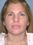 Before rhinoplasty front view female patient case 5069