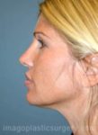 After rhinoplasty left side view female patient case 5069