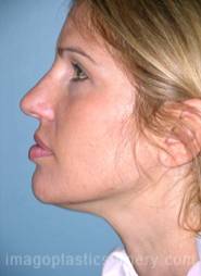 Before rhinoplasty left side view female patient case 5069