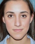 After rhinoplasty front view female patient case 5076