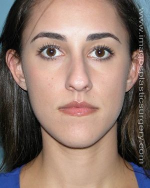 Before rhinoplasty front view female patient case 5076