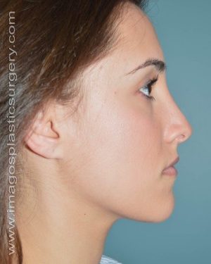 After rhinoplasty right side view female patient case 5076