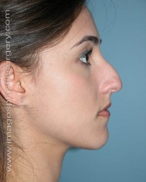 Before rhinoplasty right side view female patient case 5076