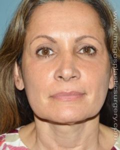 After rhinoplasty front view female patient case 5081