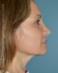 After rhinoplasty right side view female patient case 5081