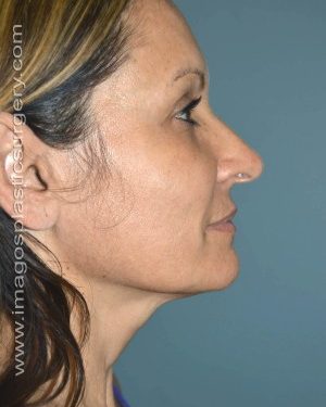 Before rhinoplasty right side view female patient case 5081