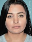 After rhinoplasty front view female patient case 5086