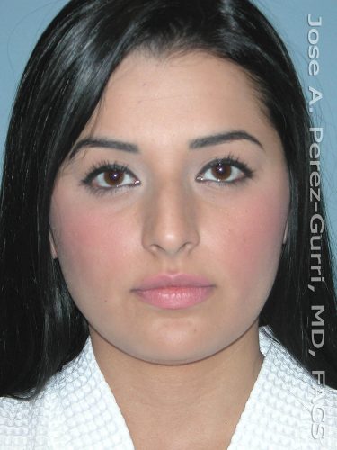 Before rhinoplasty front view female patient case 5086