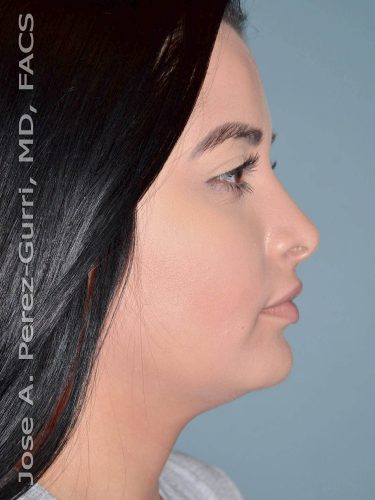 After rhinoplasty right side view female patient case 5086