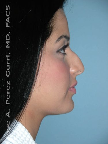 Before rhinoplasty right side view female patient case 5086